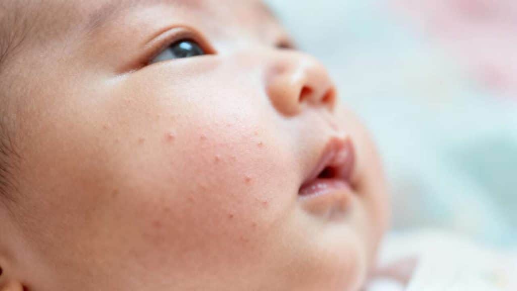 Acné du nourrisson : comment traiter les boutons ?